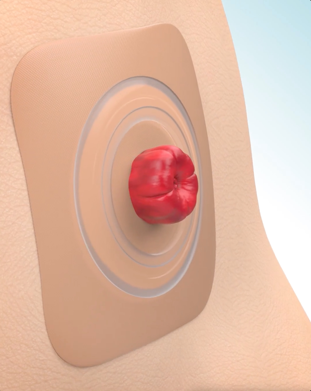 Convatec yapıştırıcılarının nasıl çalıştığını gösteren video