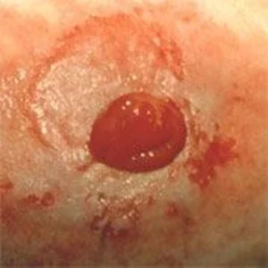 Geïrriteerde peristomale huid