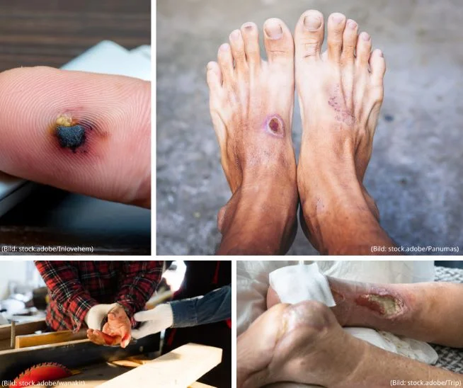 Eine Fotocollage mit 4 Bildern die verschiedene Wundarten zeigen. Darauf zu sehen zwei Bilder mit einem diabetischen Fußulcus, darunter eines mit einer Fußamputation. Eine akute Schnittwunde am Finger nach einem Unfall mit der Kreissäge und einen verletzten Finger mit Bluterguss und Wundexsudat.