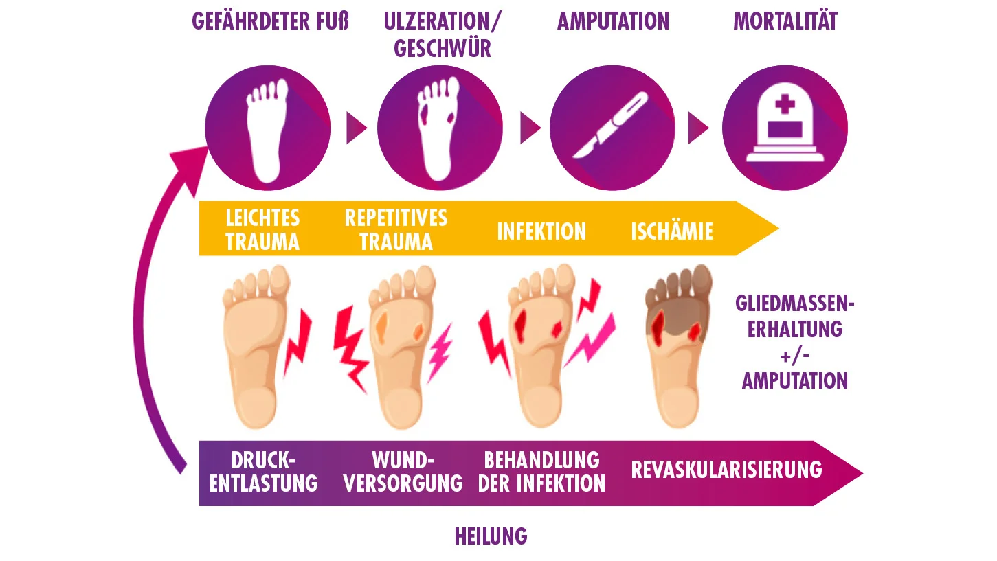 Eine Grafik mit Füßen, die die Phasen der Ulzerationen und Amputation der unten Extremitäten beim DFU darstellt