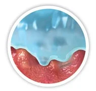 drawing of Micro-Contours to Wound Bed