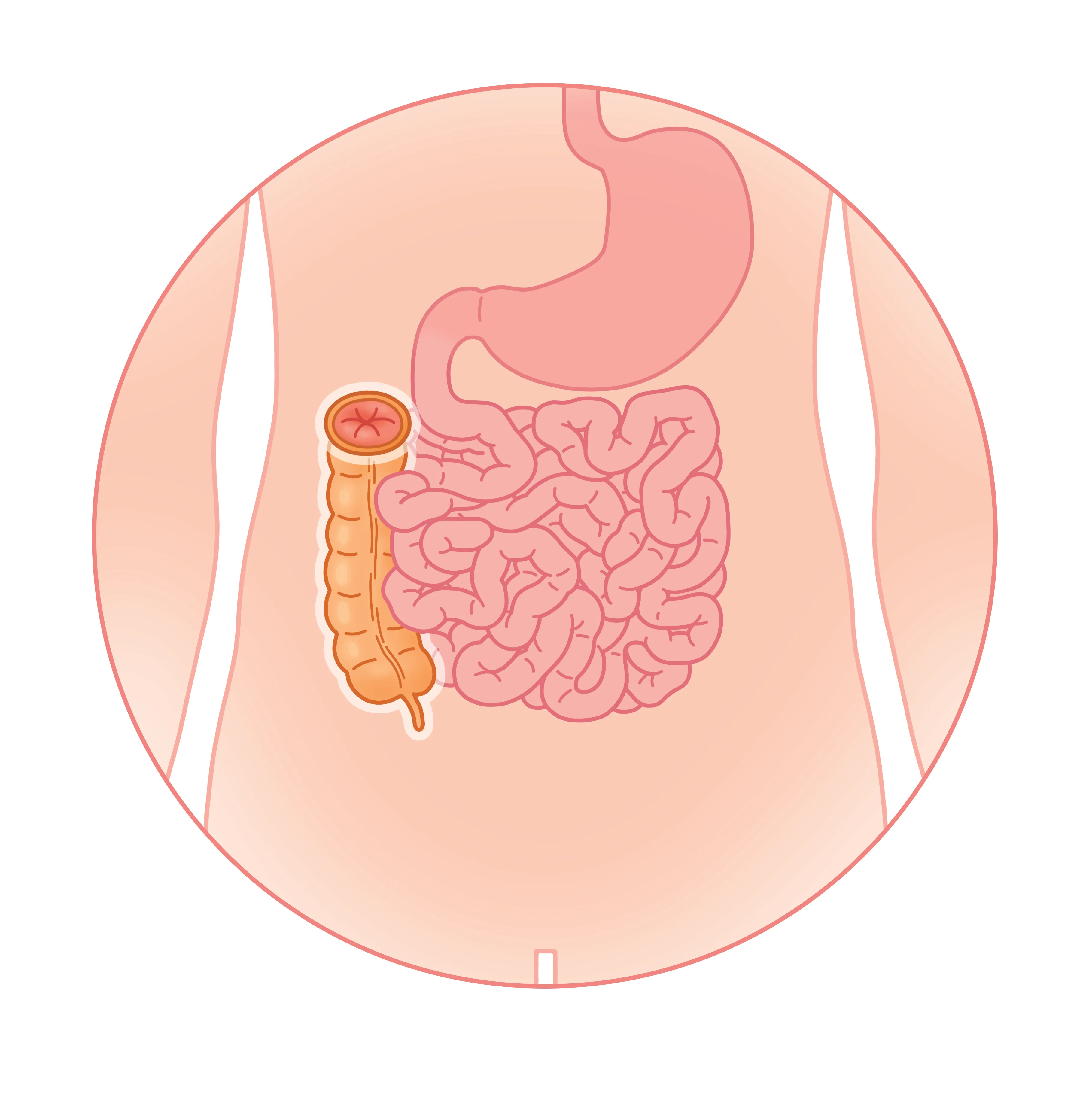 Colostomie droite